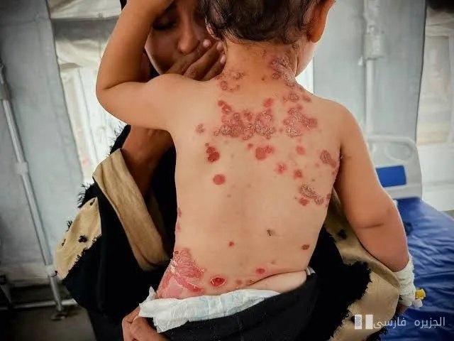 هشدار دکتر رائد ابوسریه درباره گسترش بیماری‌های پوستی در غزه